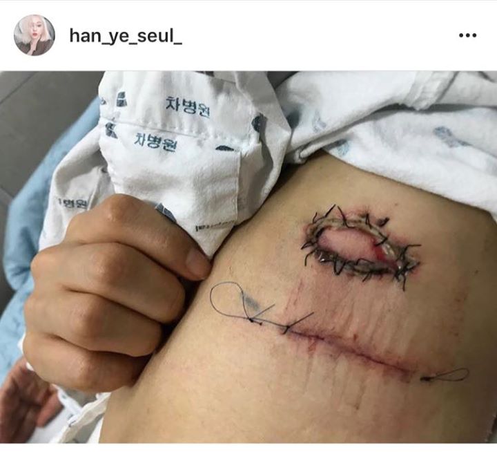 Han Ye Seul: “Trong quá trình phẫu thuật loại bỏ khối u mỡ thì tôi gặp sự cố nên mới có vết thương này.