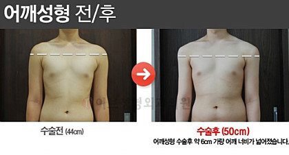 [Instiz] Xu hướng mới nhất: phẫu thuật vai