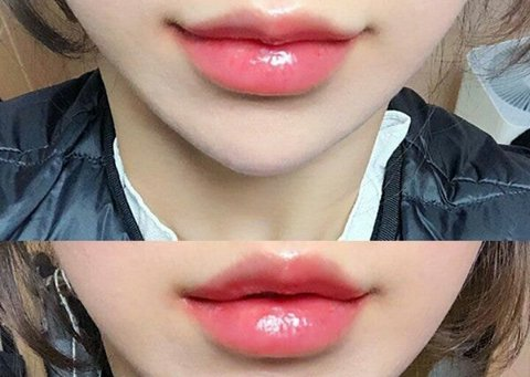 [Pann] Kiểu phẫu thuật môi đang là xu hướng dạo gần đây ㄷㄷ