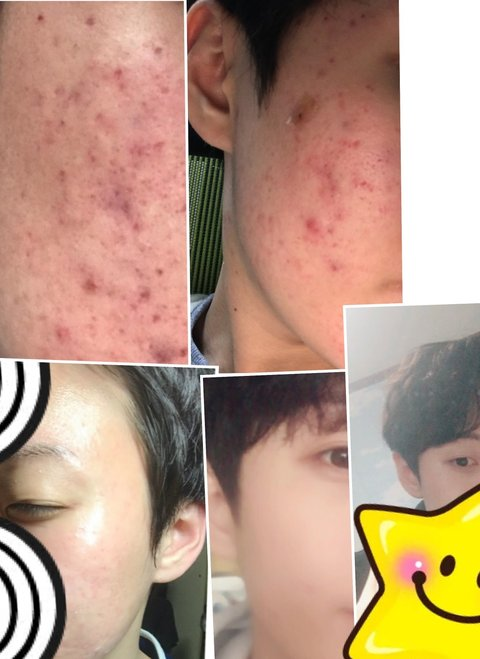 Pann: Những bạn da mụn, mau vào đây xem này