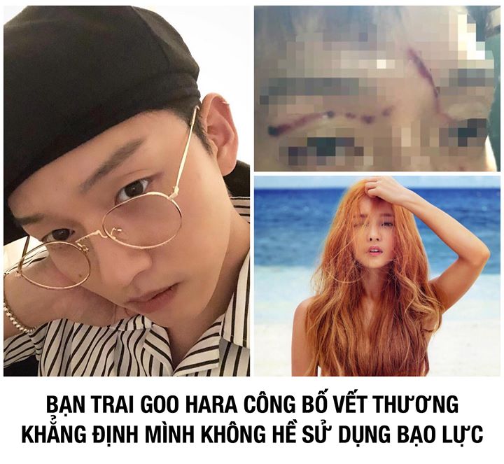 “Tôi đề nghị chia tay trước vì tính cách khác biệt. Nhưng việc báo chí đưa tin 2 bên đều sử dụng bạo lực là không đúng.” Jong Bum nói rằng mình đang phải điều trị sẹo. Phóng viên nhận thấy có 3 vết sẹo trên mặt Jong Bum, một vết 3cm trên mặt, một vết 4cm 